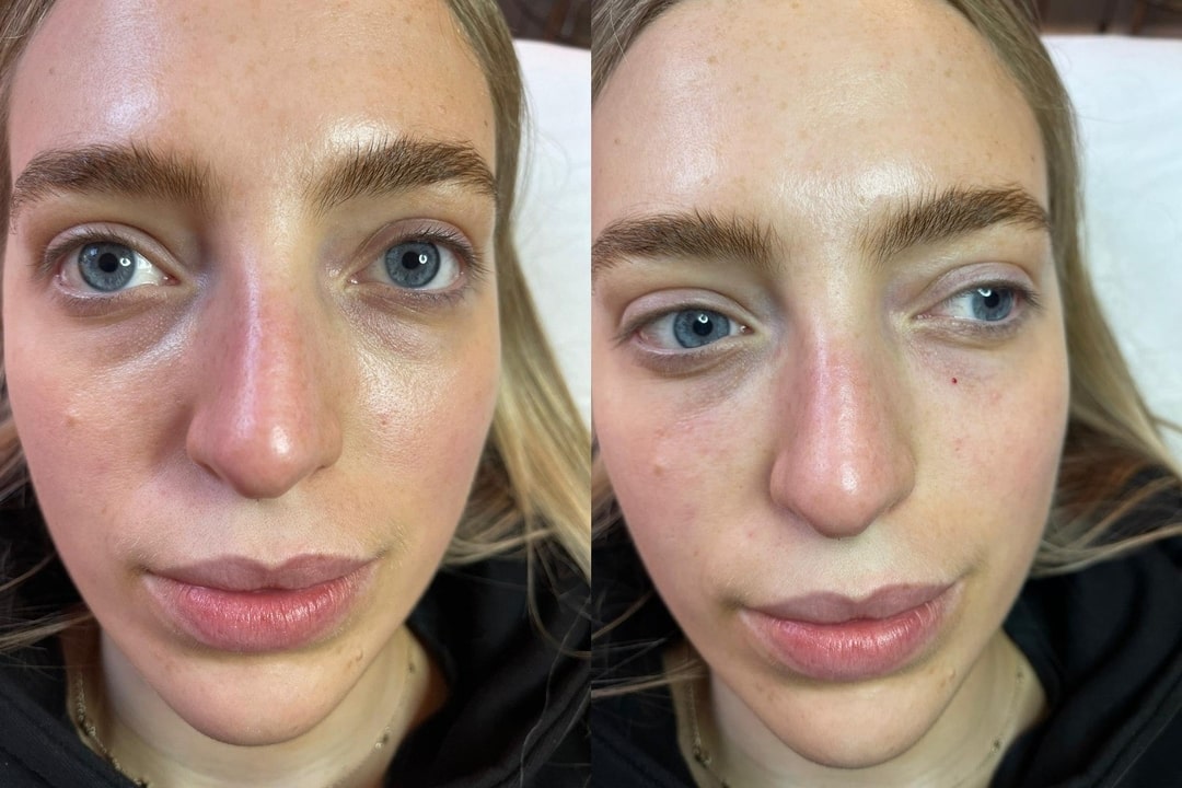 Tear Trough Filler Before and After Tear Trough Treatment Price